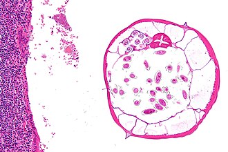 Enterobius vermicularis (Appendix)